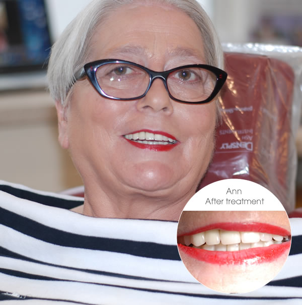 smile makeover ann after treatment at brunswick dental